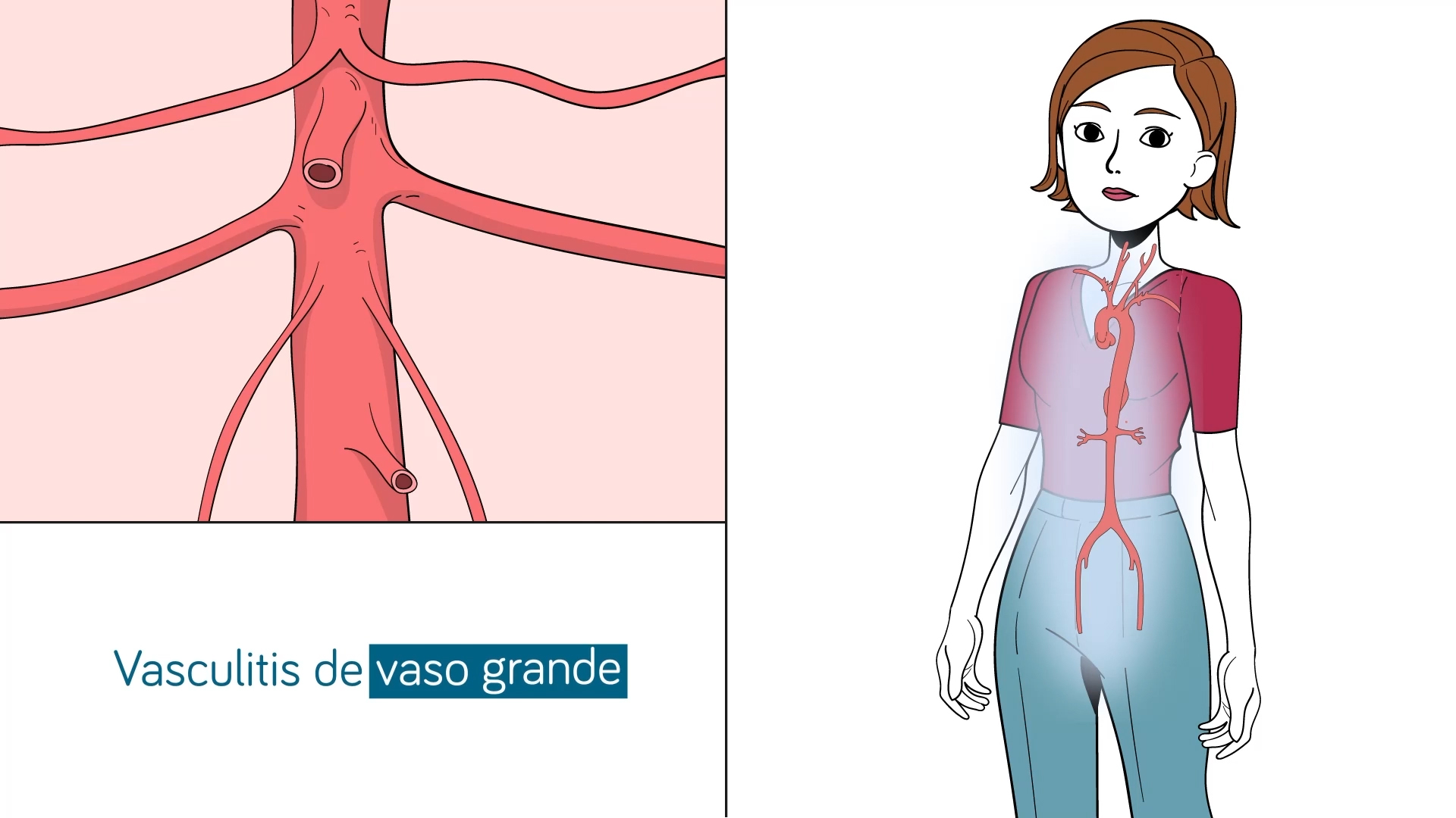Arteritis de Takayasu