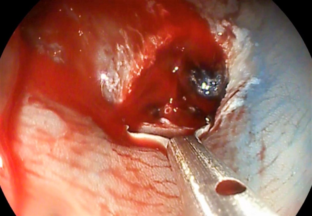 herramientas de la endoscopia.
