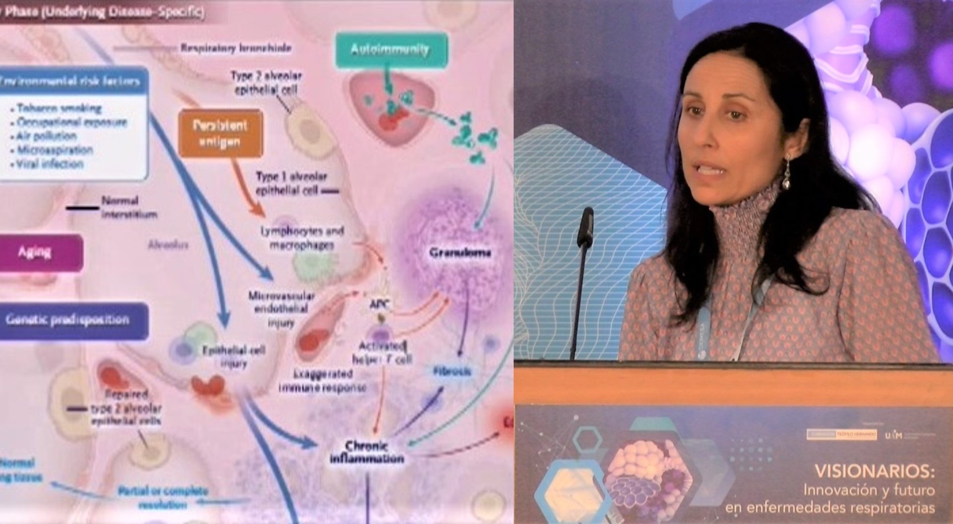 enfermedades intersticiales pulmonares: fibrosis