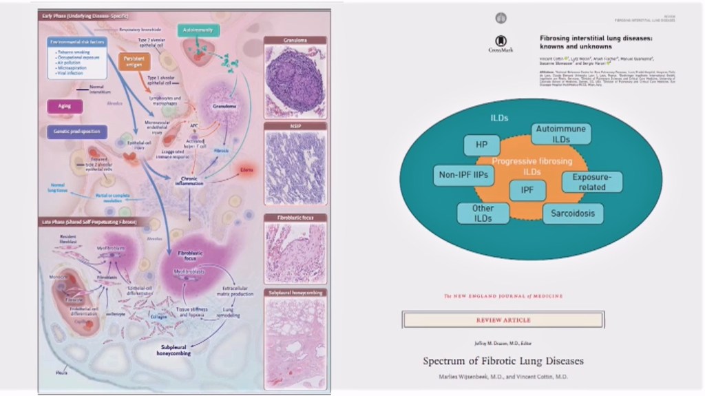 enfermedades intersticiales pulmonares: fibrosis