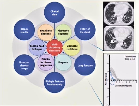 Reumatología y enfermedades intersticiales pulmonares: fibrosis