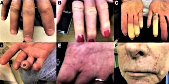 enfermedades intersticiales pulmonares: fibrosis