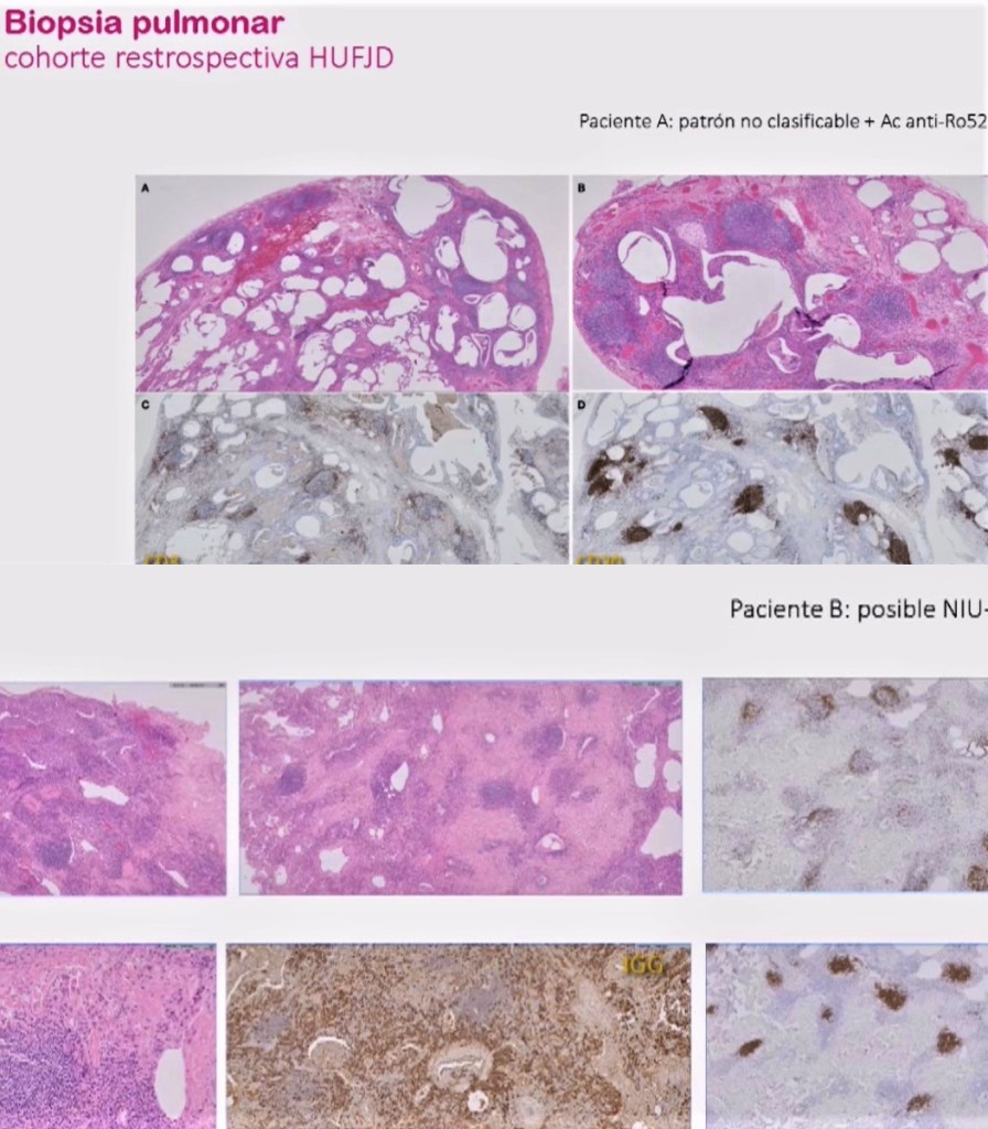 Reumatología y enfermedades intersticiales pulmonares: fibrosis
