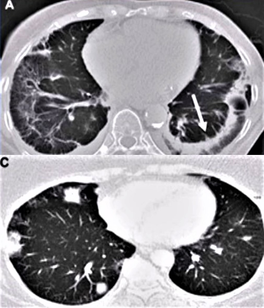 Reumatología y enfermedades intersticiales pulmonares: fibrosis