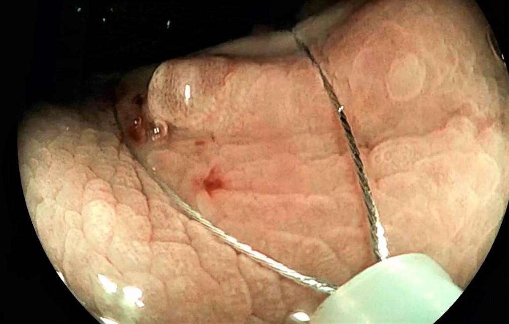 Mitos endoscopias digestivas