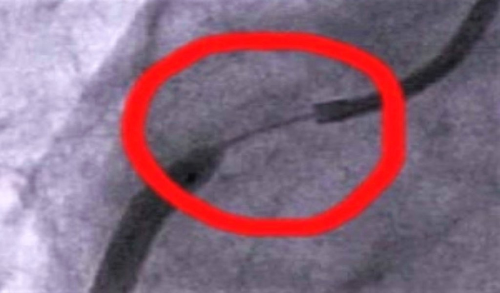 Calcificación vascular.