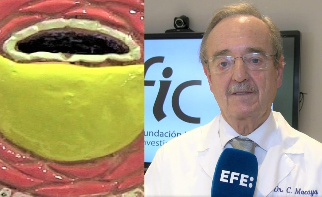 Calcificación vascular
