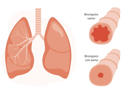 Día Mundial Asma