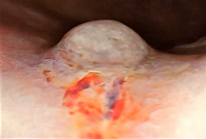 Cáncer gástrico.