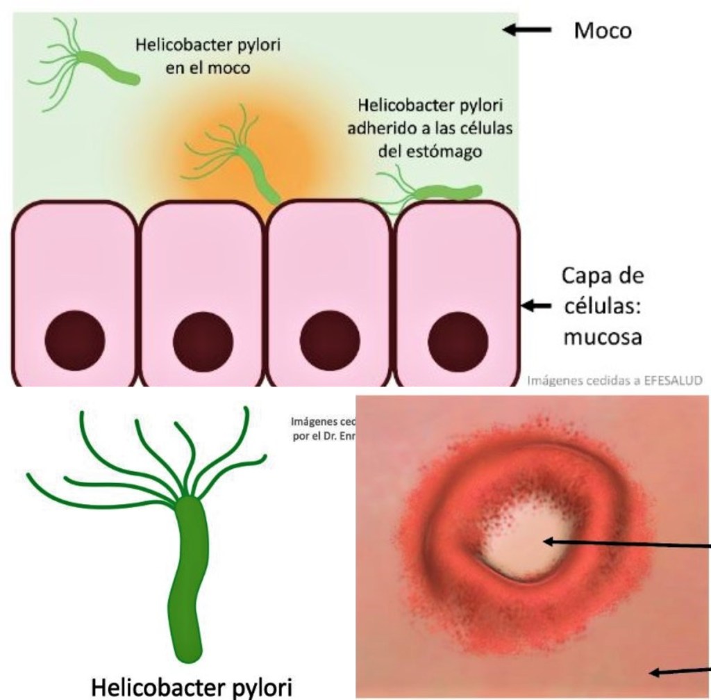 cáncer de estómago