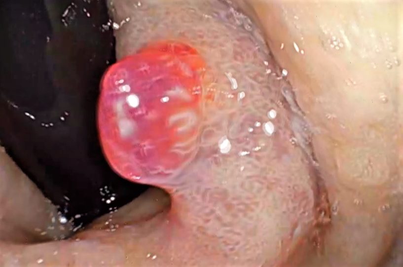 Cáncer de estómago