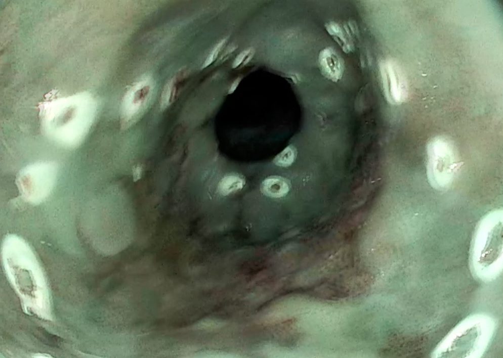 Edoscopia predictiva del cáncer en el tubo digestivo