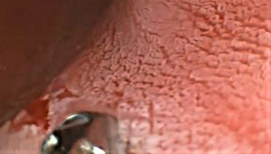 Edoscopia predictiva del cáncer en el tubo digestivo
