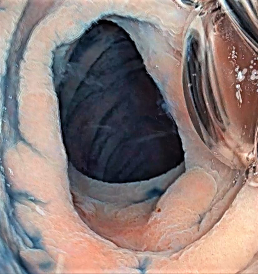 Edoscopia predictiva del cáncer en el tubo digestivo