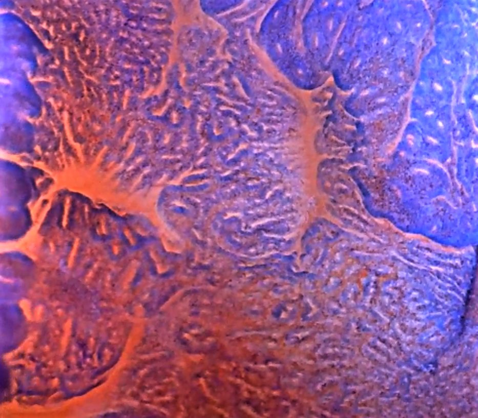 Edoscopia predictiva del cáncer en el tubo digestivo
