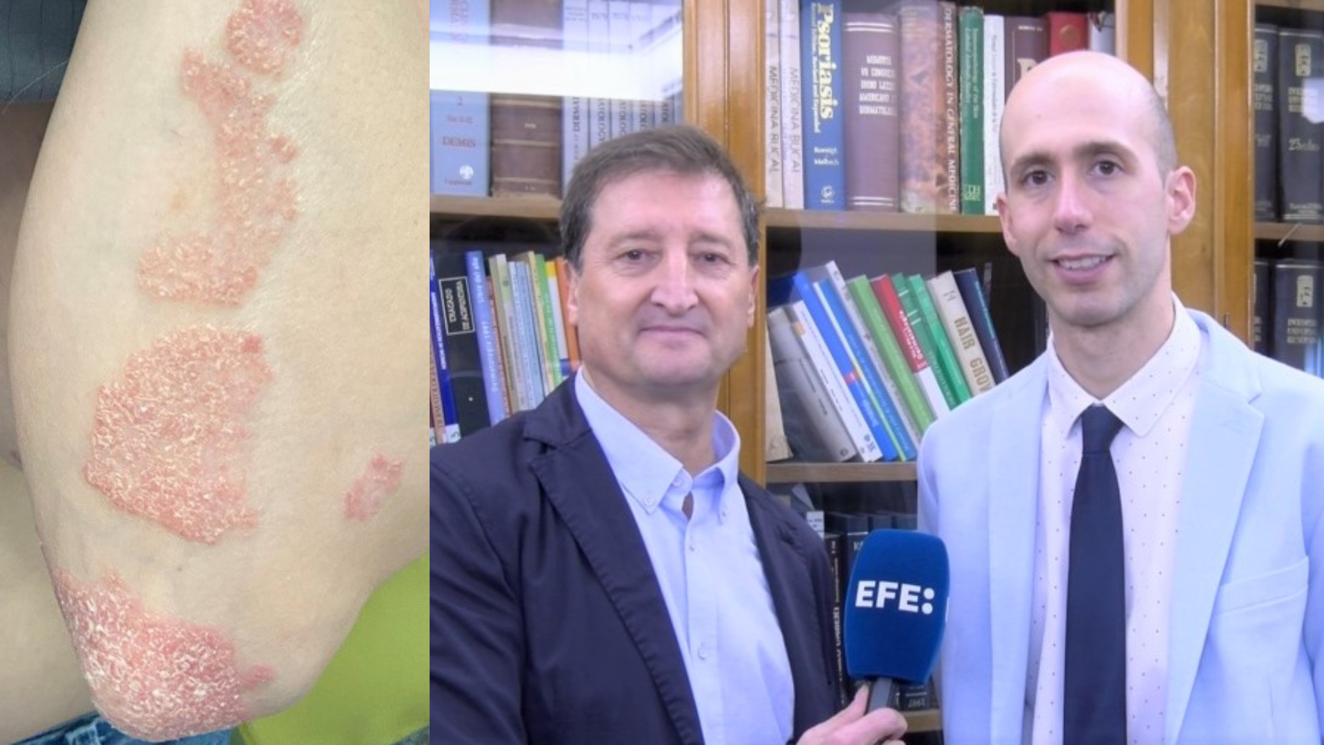 Psoriasis, actualización médicamentos.