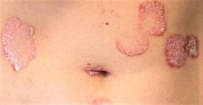 Psoriasis, actualización médicamentos.
