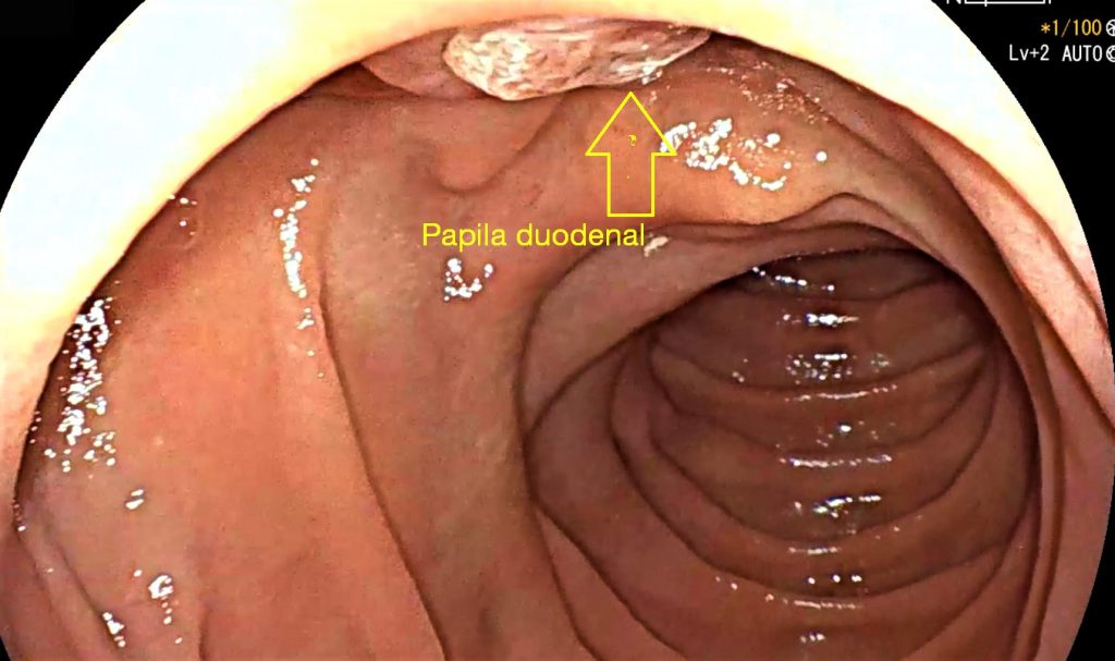 Viaje endoscópico por el tubo digestivo: estómago y duodeno.