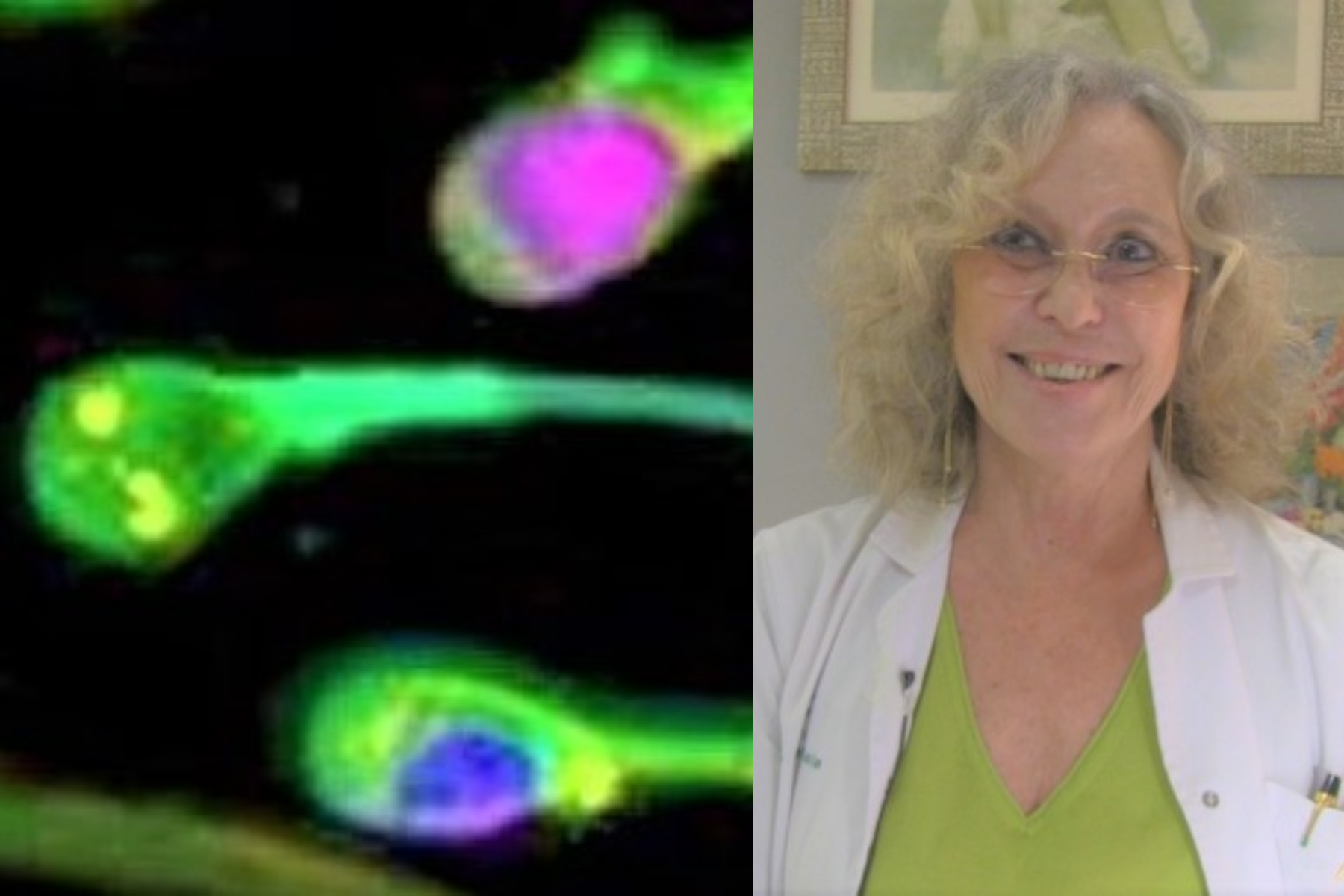 La fragmentación del ADN del espermatozoide.