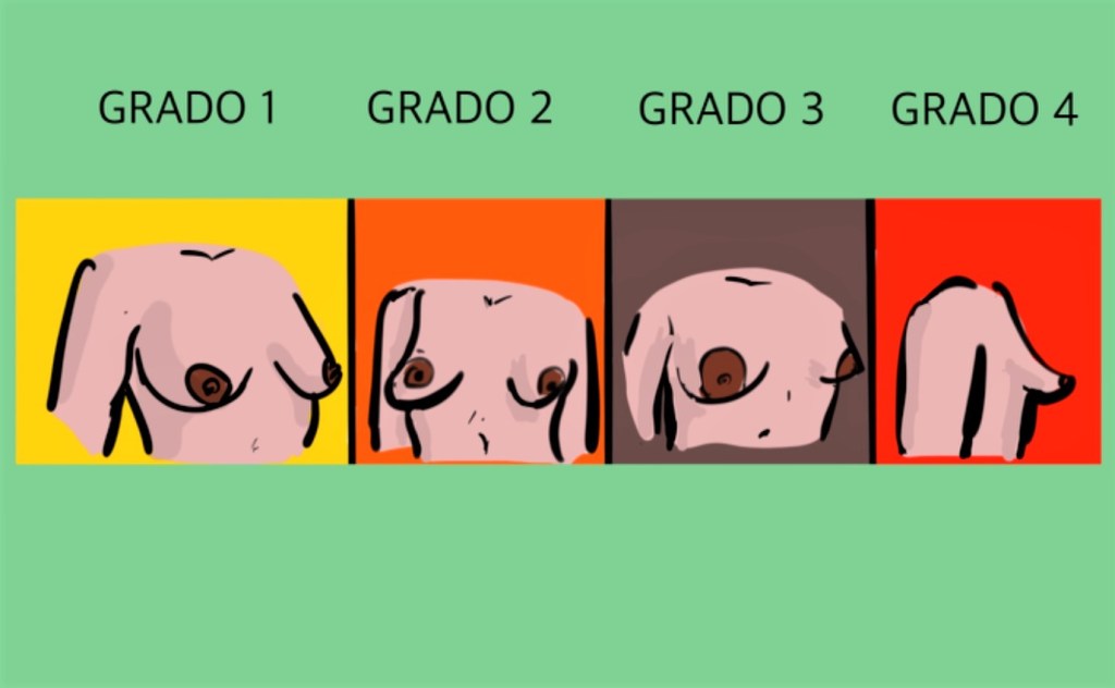Grados de mamas tuberosas que afectan a las mujeres.