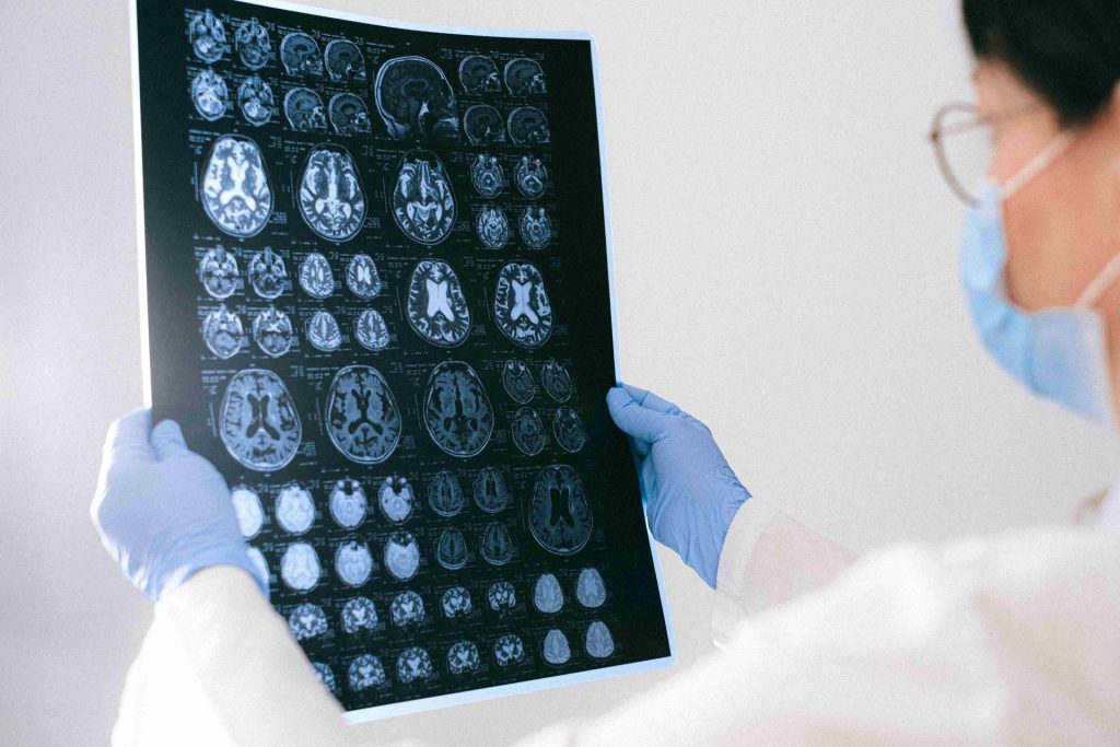 Epilepsia factores de riesgo