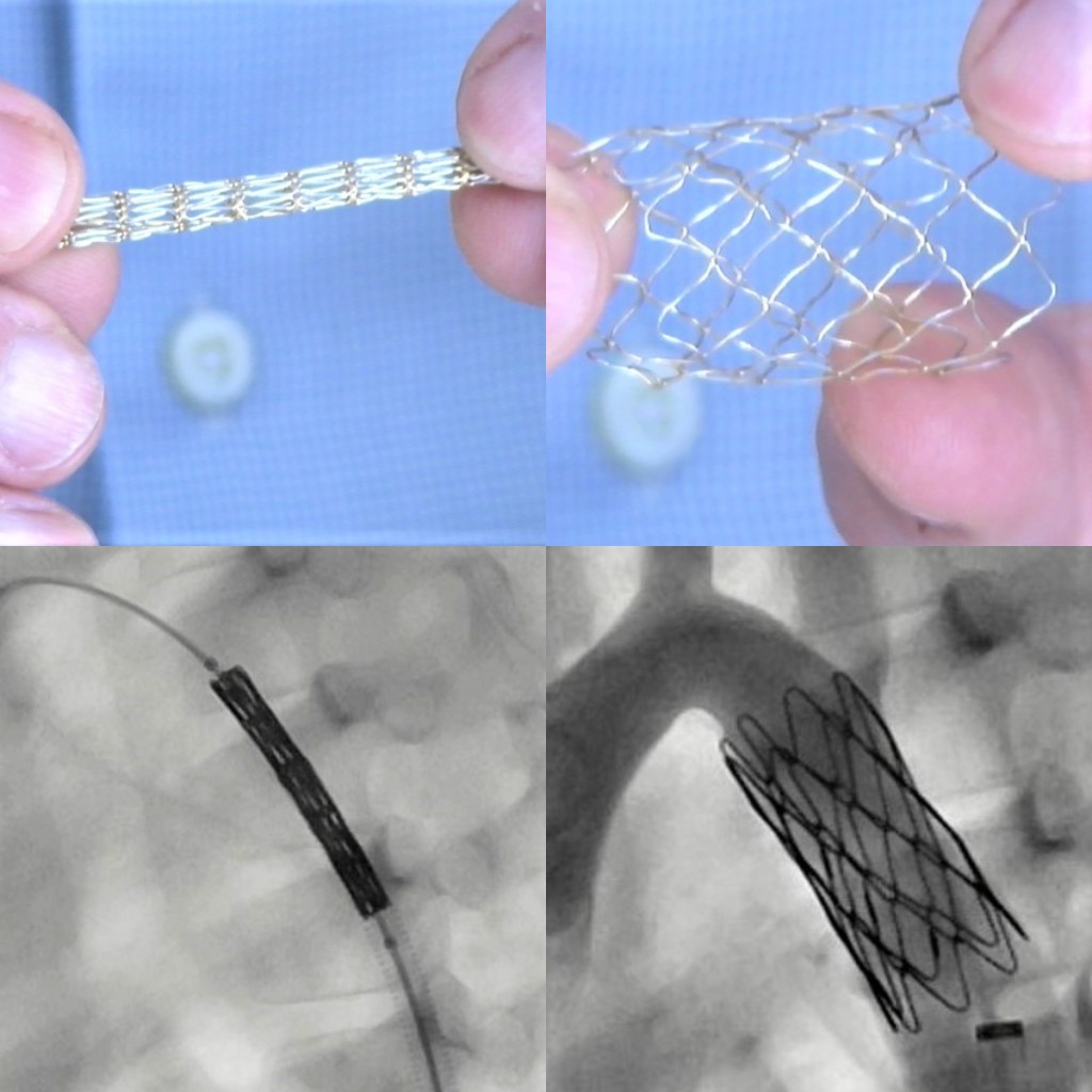 Stent para arterias obstruídas, estenóticas.