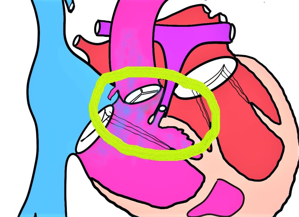 Cardiopatías congénitas.