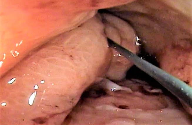 Perforaciones endoscópicas digestivas.