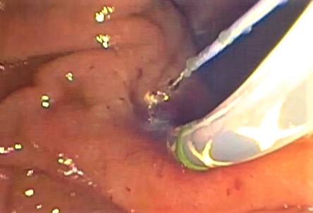 Perforaciones endoscópicas digestivas.