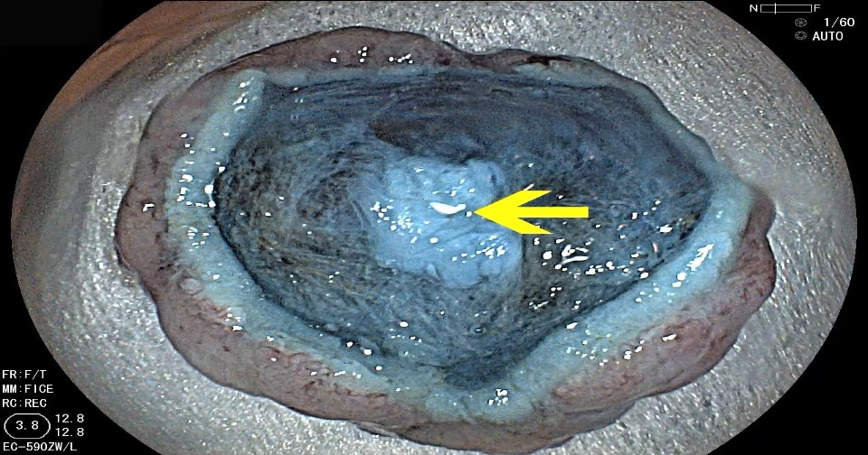 Perforaciones endoscópicas digestivas.