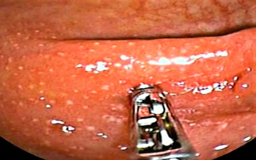 Perforaciones endoscópicas digestivas.