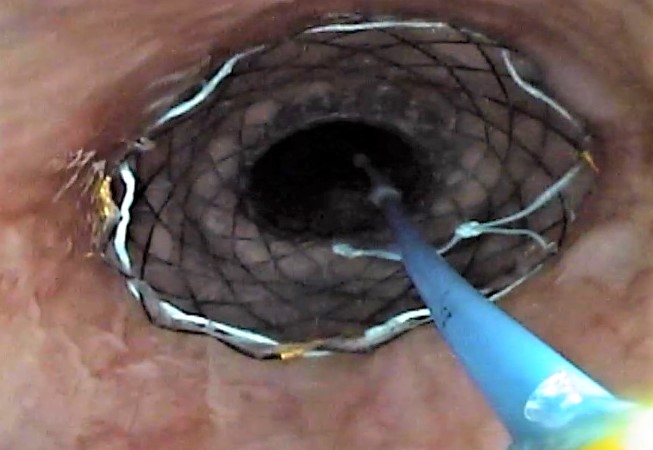 Perforaciones endoscópicas digestivas.
