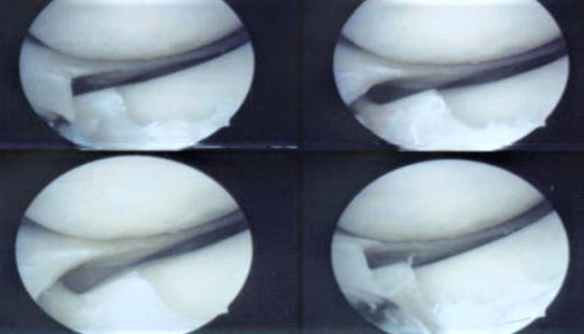 Voces de la rodilla.