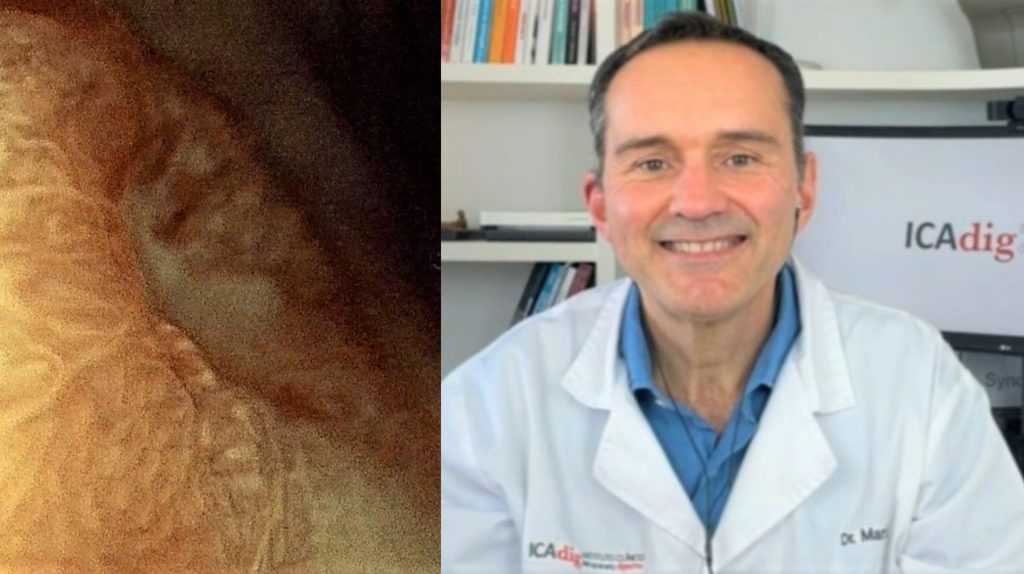 Una úlcera gástrica que en realidad es una neoplasia maligna.