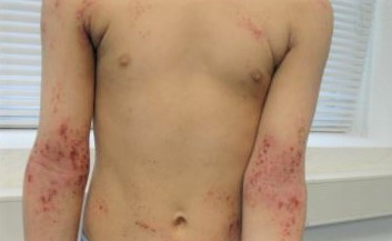 Dermatitis atópica.