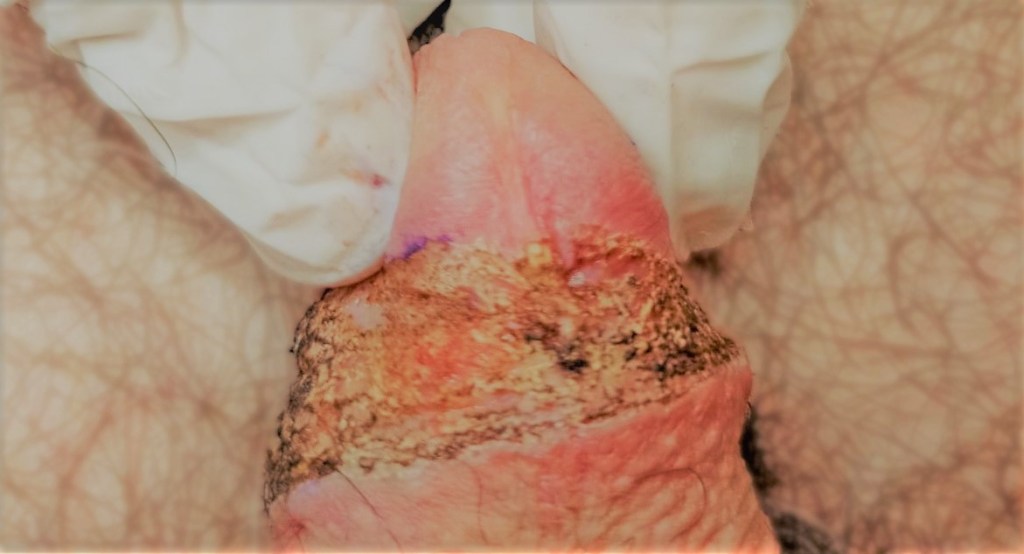 Lesión precancerosa en el glande.