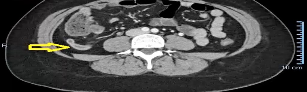 Tomografía de una apendicitis.