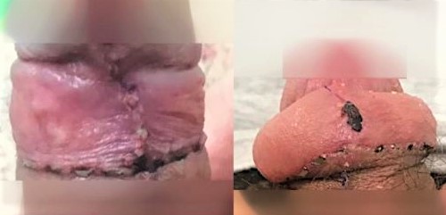 Cirugía de circuncisión.